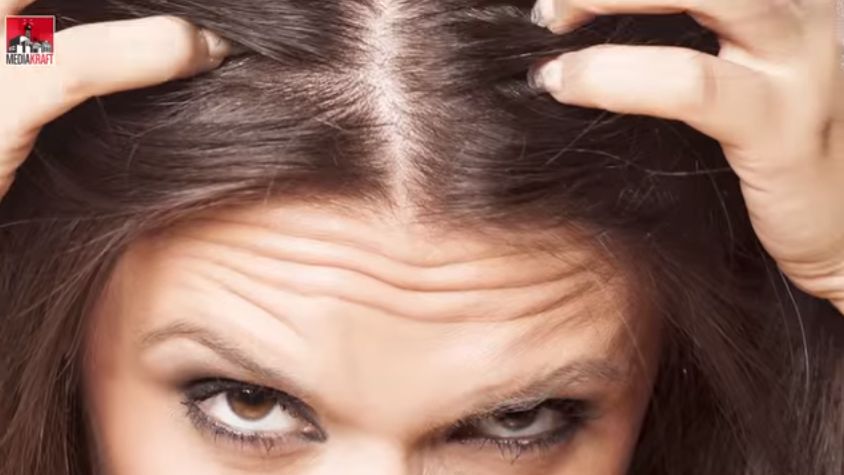 Wypadające włosy potrafią być prawdziwym utrapieniem 