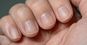 Masz takie plamki na paznokciach? Lekarz ostrzega