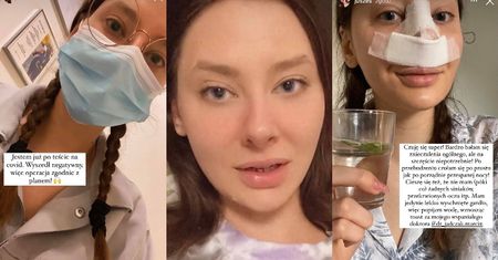 Justyna z "Big Brothera" poddała się operacji plastycznej: "Mój nos jest PORZĄDNIE POKIERESZOWANY" (ZDJĘCIA)