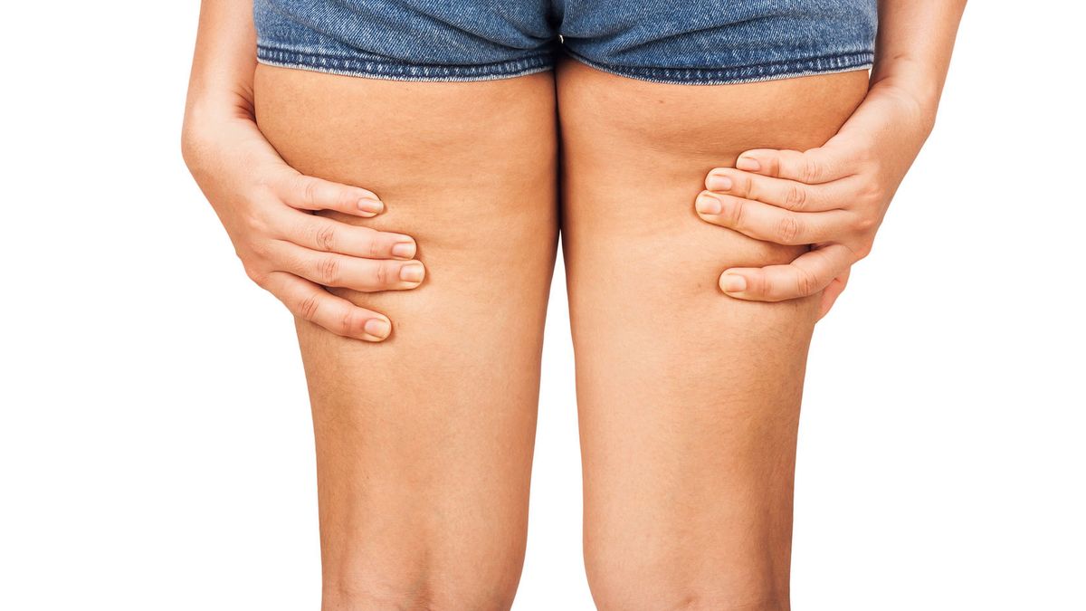 Cellulit u kobiet tworzy się głównie z powodu hormonów