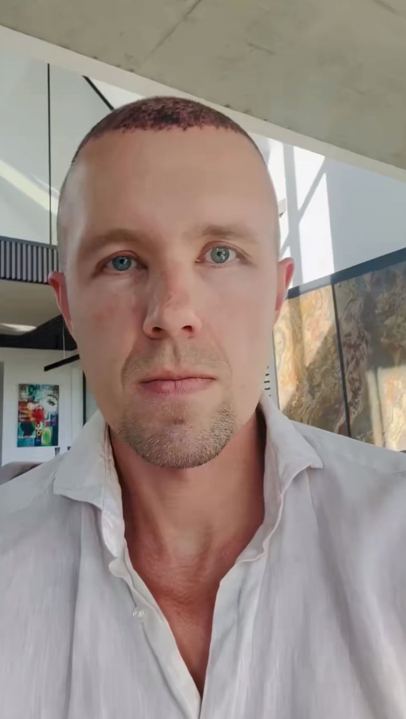 Dawid Piątkowski relacjonuje przeszczep włosów