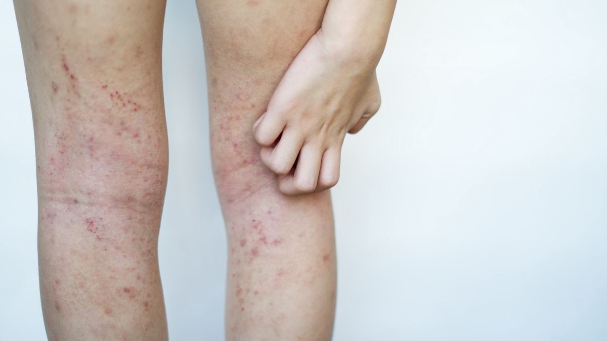 Allergy skin of an Asian kid on her legs with hand to scratch in natural light.Allergy skin of an Asian kid on her legs with hand to scratch in natural light.Fobo