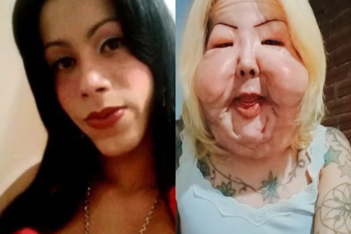 Podano jej 21 zastrzyków. Tak Brazylijka wygląda po nieudanej operacji