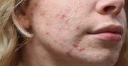 Nie możesz pozbyć się trądziku? Sprawdź, czy nie popełniasz tego popularnego błędu