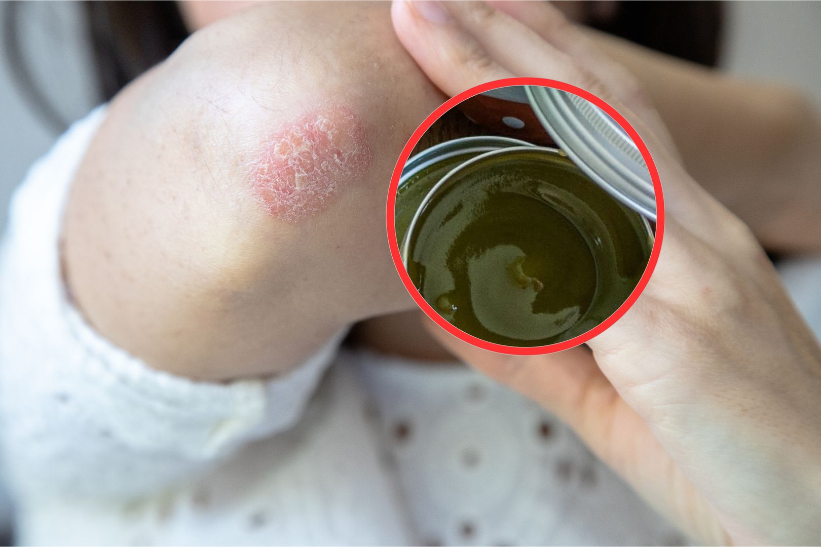 Koniec z problemami skórnymi. Ta maść z PRL-u działa cuda