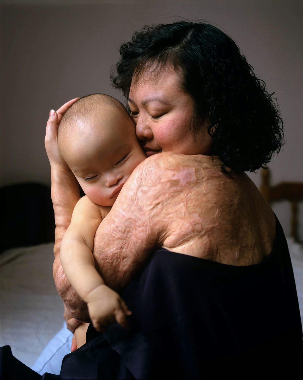 Phan Thi Kim Phucm na zdjęciu razem ze swoim synkiem, do dziś nosi ślady wojny na swoim ciele. Fotografia wykonana w 1995 roku dla magazynu LIFE.