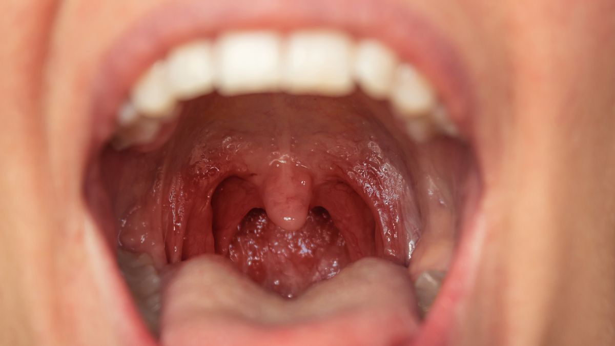 Kamienie migdałkowe - jak zapobiegać?