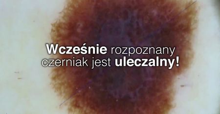 Czerniak. Jak się przed nim chronić?