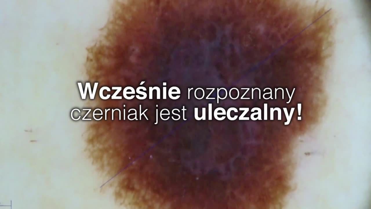 Czerniak. Jak się przed nim chronić?