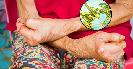 Pierwszy od ponad 40 lat przypadek trądu w Rumunii. Cztery kobiety pod nadzorem epidemiologicznym