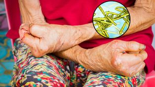 Pierwszy od ponad 40 lat przypadek trądu w Rumunii. Cztery kobiety pod nadzorem epidemiologicznym