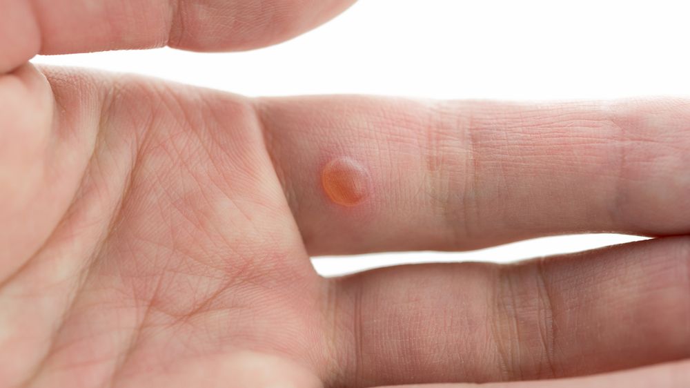 Usuwanie brodawek - rodzaje brodawek, sposoby ich usuwania, profilaktyka