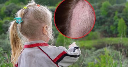Wyrywają sobie włosy. "To silniejsze od nich". Czym jest trichotillomania?