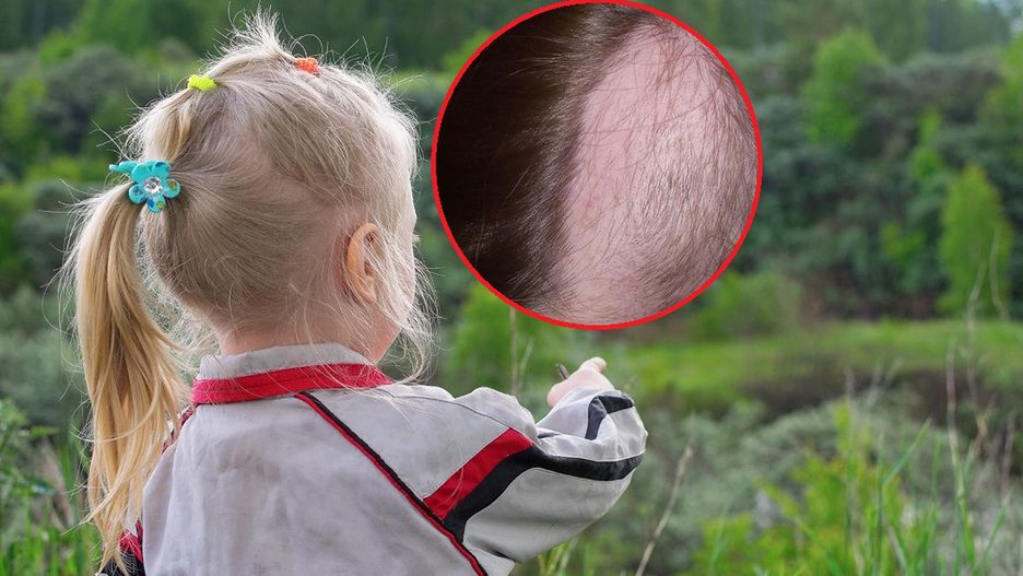 Głowa dziecka cierpiącego na trichotillomanię
