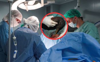 To była kula włosów. Odkrycie w żołądku 10-latki z Indii