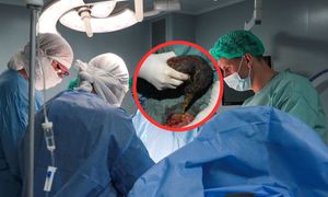 To była kula włosów. Odkrycie w żołądku 10-latki z Indii