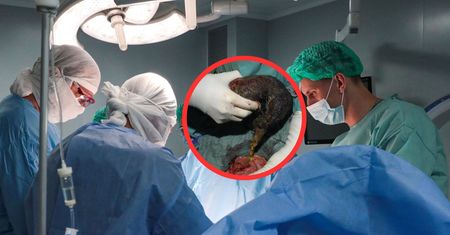 To była kula włosów. Odkrycie w żołądku 10-latki z Indii