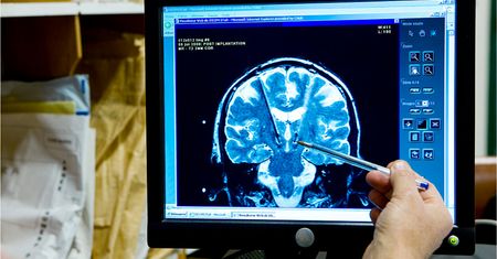 38-latek miał w głowie tasiemca. Przerażająca diagnoza postawiona w Anglii