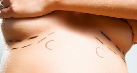 Koniec powiększania piersi nastolatkom!