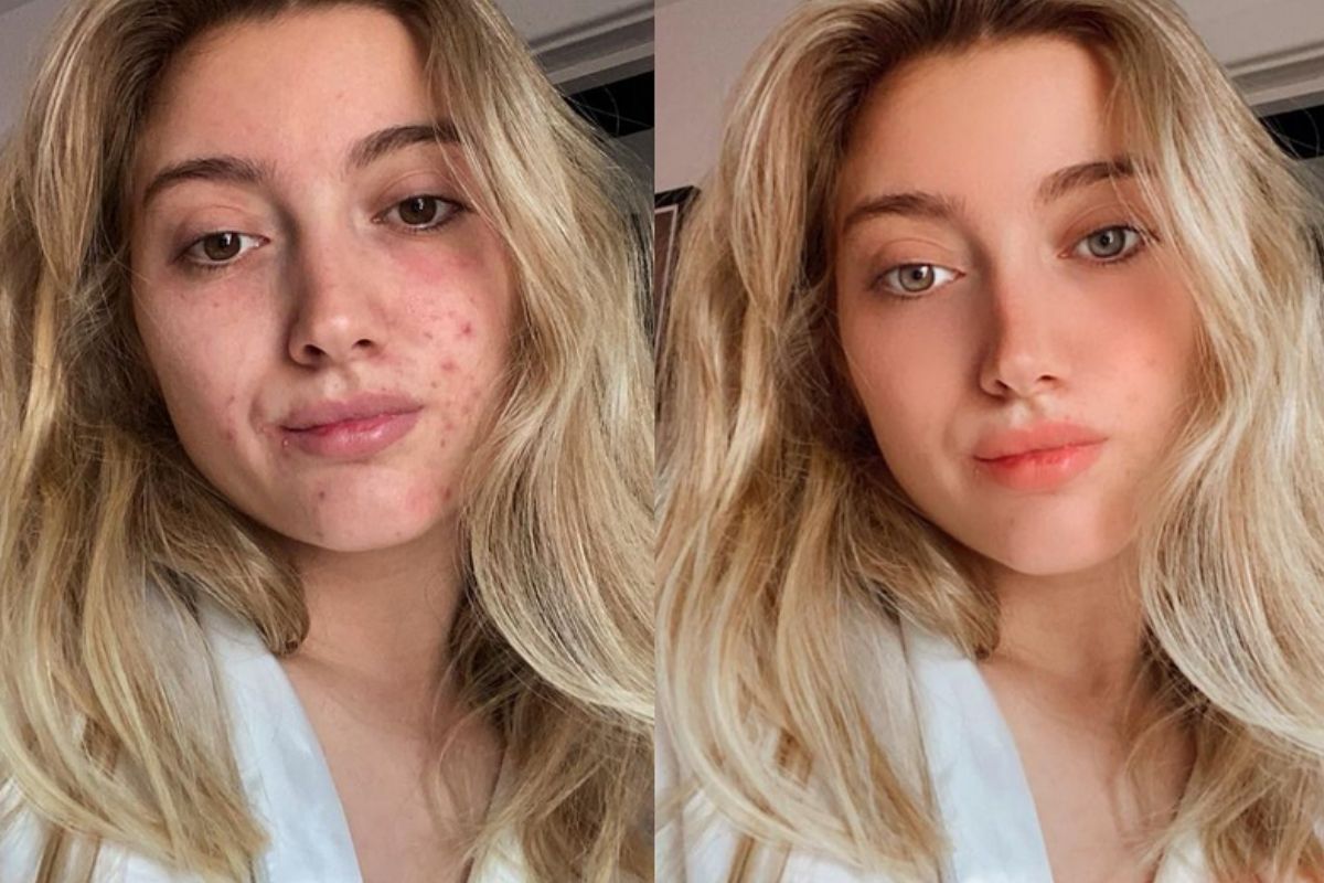 Jak zmieniają się trendy w świecie mody? Modelka z trądzikiem zrobiła w ...