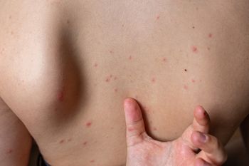 Krosty na plecach? Sprawdź, czy nie popełniasz tych błędów