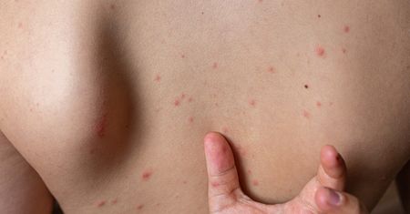 Wiele osób zapomina. To może powodować wypryski na plecach