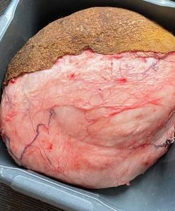 Wrocław. Guz ważył 6 kilogramów. Rita już po operacji