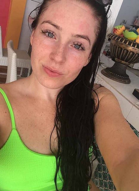 Wyeliminowanie z diety cukru i nabiału pomogło 29-latce w walce z łuszczycą. 