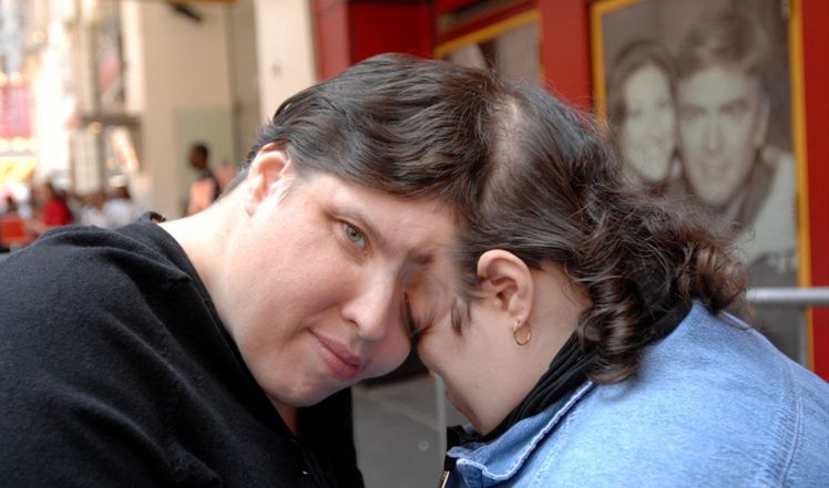Najsłynniejsze bliźnięta syjamskie żyją razem od 61 lat