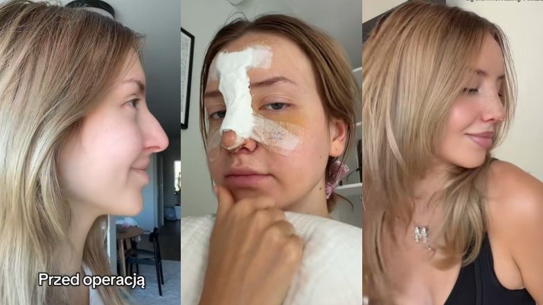 Influencerka Monika Kociołek zrobiła OPERACJĘ NOSA