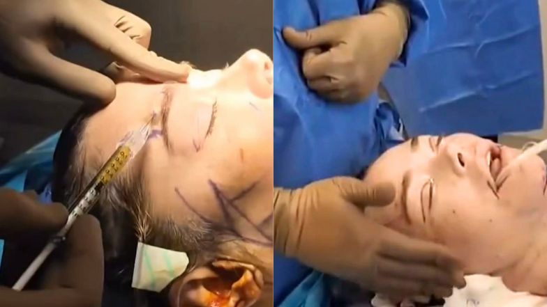 Denise Richards pokazała nagranie z liftingu twarzy