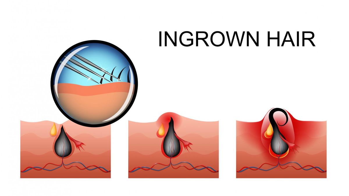 Każda kobieta przynajmniej raz w życiu znalazła na swoim ciele wrastający włos.