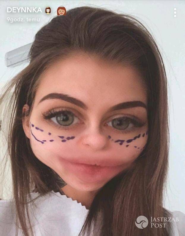 Deynn relacjonuje samopoczucie po operacji plastycznej