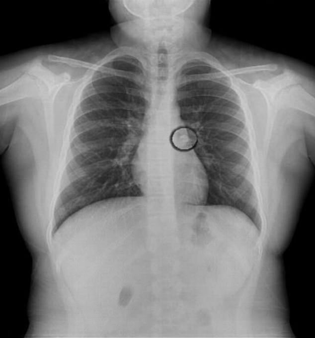 Ząb utknął w oskrzelach dziewczynki