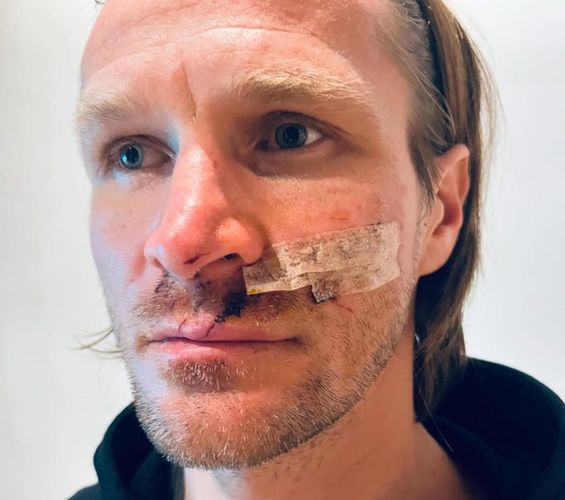 Tadeusz Błażusiak po operacji uszkodzonej twarzy