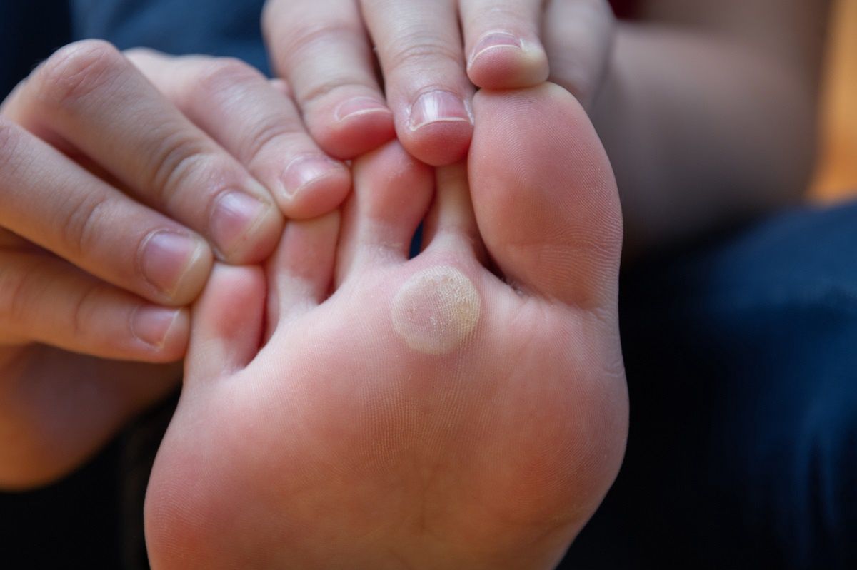 Kick out foot calluses at home. The surprising power of kitchen ingredients