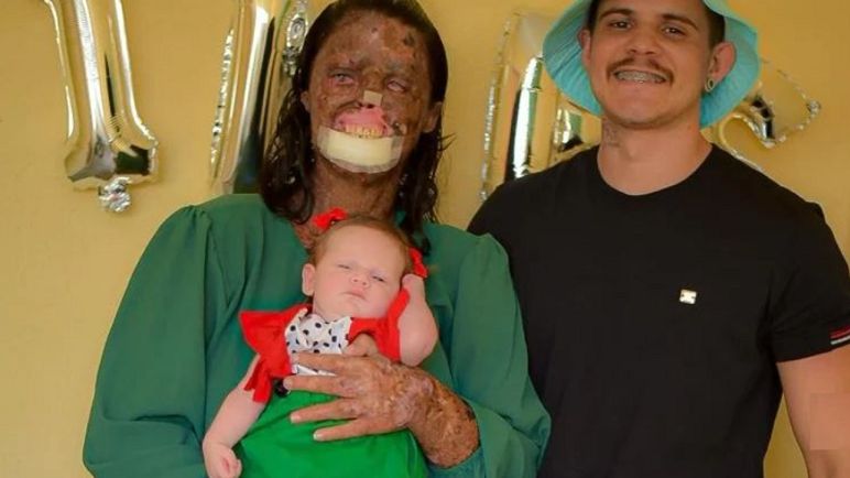 Od dziecka walczy z rzadką chorobą. Z powodu wyglądu była nazywana potworem