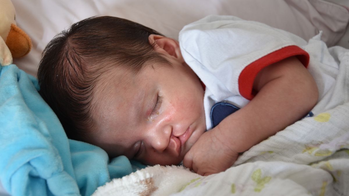 Rozszczep podniebienia to wada rozwojowa powstała we wczesnym okresie rozwoju płodu. To szczelina lub przerwa powstała na skutek niepołączenia się struktur podniebienia.