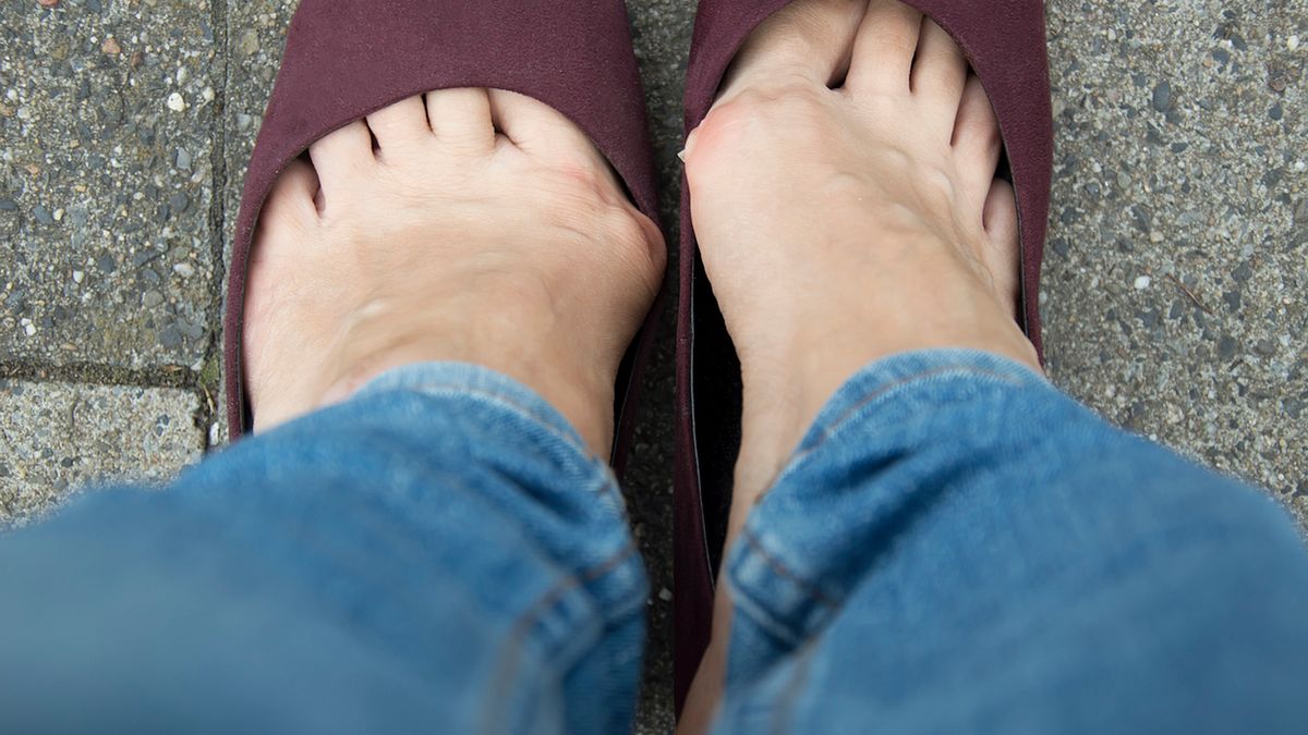 Haluksy to koślawe palce stóp, które nie tylko brzydko wyglądają, ale także bolą