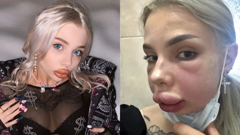 Rosyjska influencerka chciała zmniejszyć usta