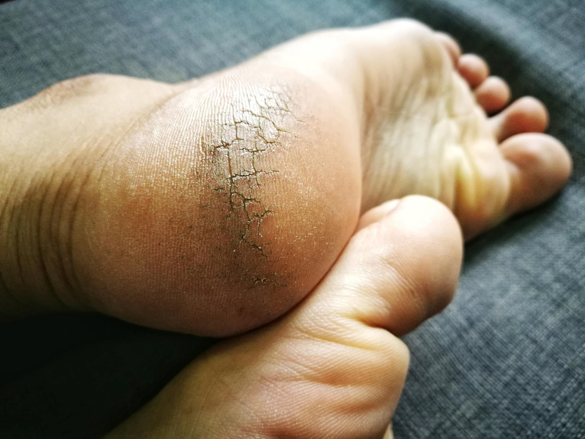 Pękające pięty to nie tyko defekt kosmetyczny