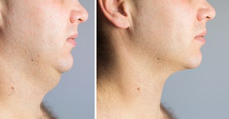 Drugi podbródek – przyczyny, ćwiczenia, masaże, medycyna estetyczna, inne metody