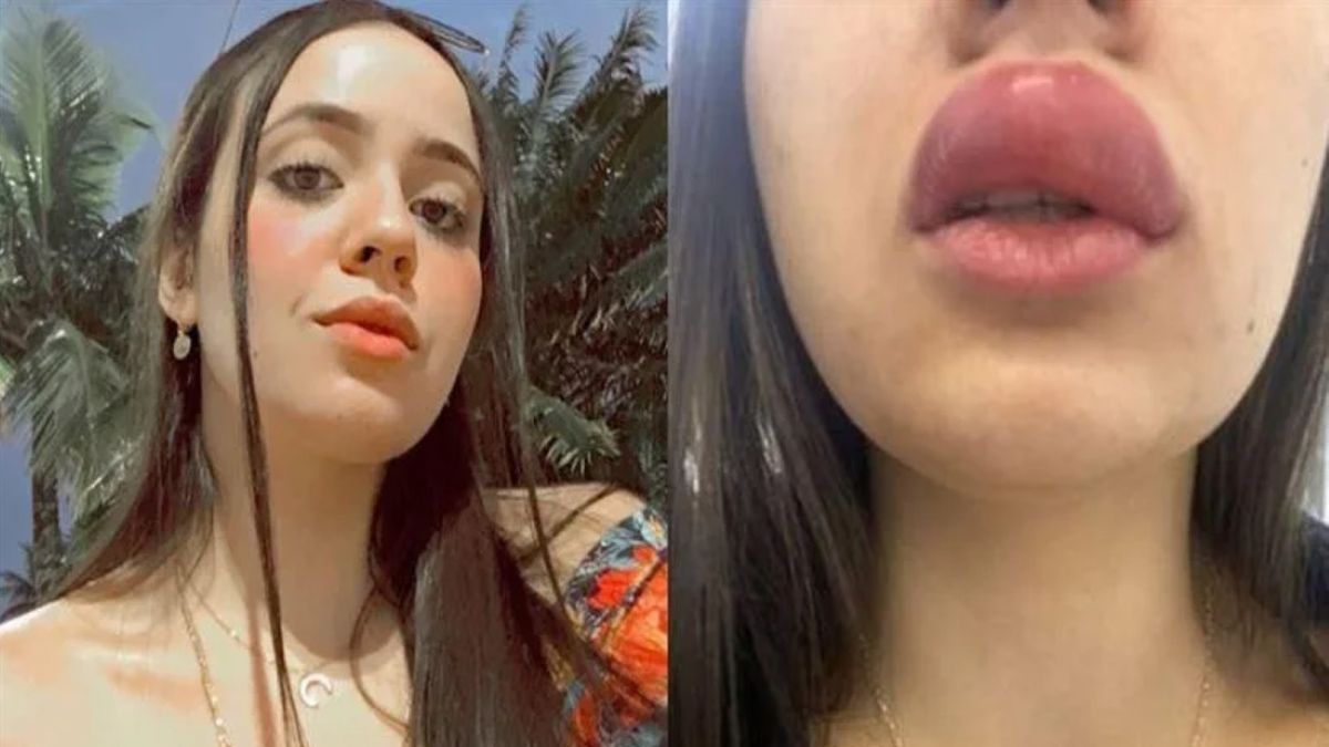 Nataly Galdino została ukąszona w usta przez jadowitą stonogę 