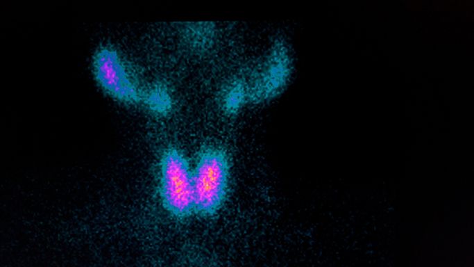 Scyntygrafia receptorowa to obrazowe badanie diagnostyczne.