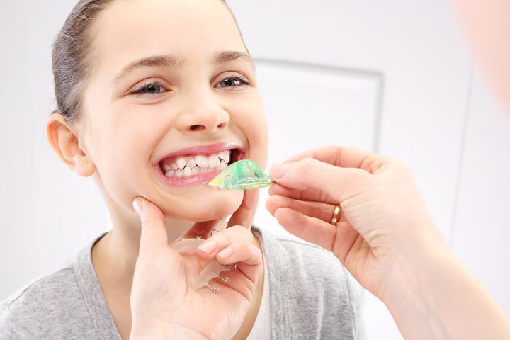 Stłoczone zęby najczęściej leczone są za pomocą aparatu ortodontycznego.