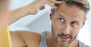 Problem łysienia u mężczyzn - kiedy warto zdecydować się na przeszczep włosów?