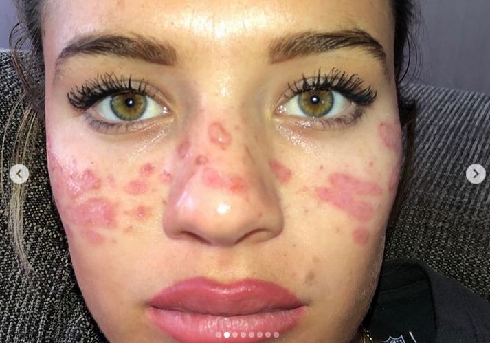 21-latka omal nie straciła wzroku. 