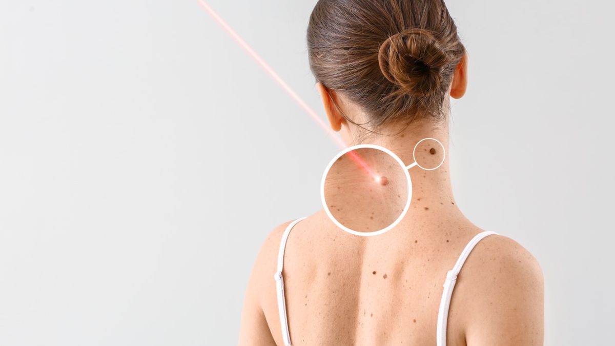 Brodawka łojotokowa to łagodna zmiana nowotworowa pochodzenia naskórkowego.