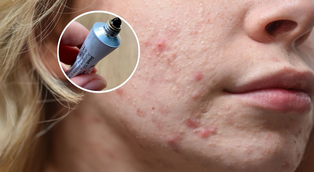 Hitowa maść "wyciąga" pryszcze w jedną noc. Kosztuje tylko 5 złotych