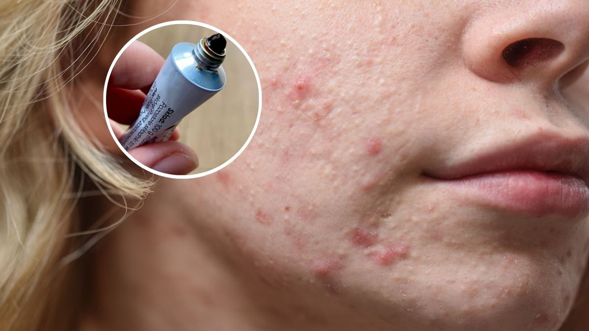 Maść ichtiolowa działa w specyficzny sposób